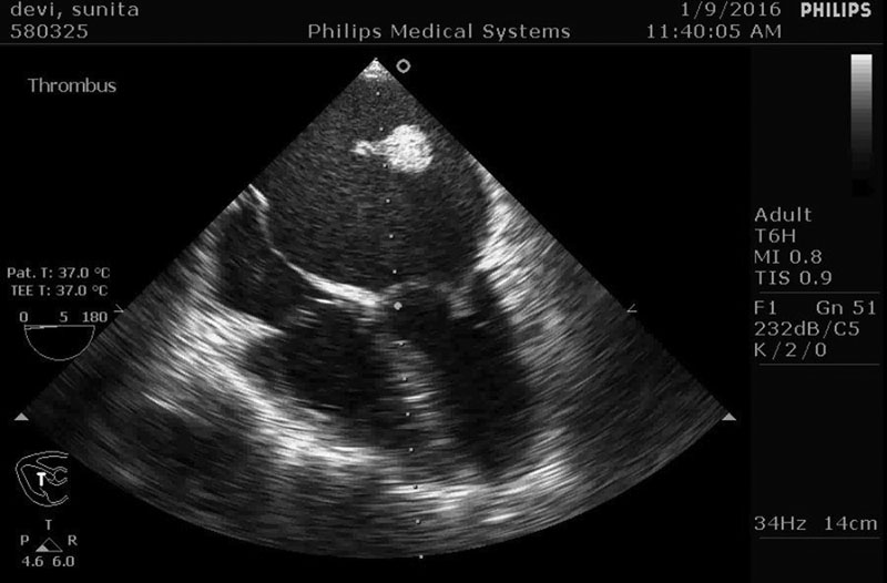 Midesophageal four-chamber view showing the dislodged thrombus freely floating in the left atrium.