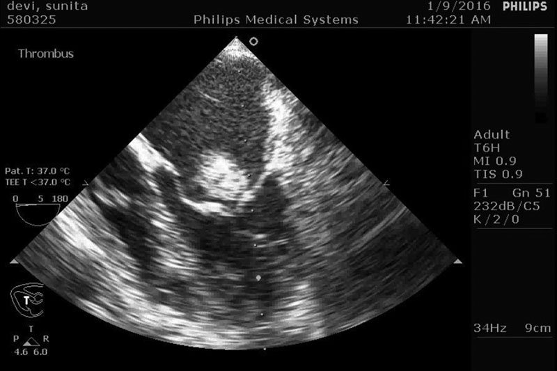 Midesophageal four-chamber view showing free-floating mobile thrombus bouncing against the thickened and tightly stenotic mitral valve.