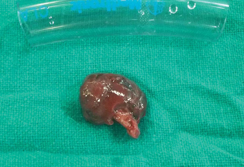 Organized thrombus as seen upon gross examination.