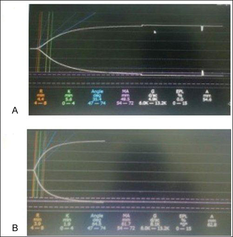 (A) Thromboelastograph at baseline and after transfusion of blood products. (B) K value decreased from 5.6 to 1.9 and maximal clot amplitude increased from 49.5 to 61.7.