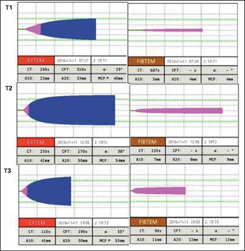 Showing EXTEM, FIBTEM parameters of rotational thromboelastometry (ROTEM) before surgery (T1) and after 4 hours (T2) and 6 hours of surgery (T3). Note the improvement in EXTEM (clot time decreased from 290 to 110 seconds, maximal clot firmness increased from 40 to 53 mm) and FIBTEM parameters (A20 increased from 4 to 12 mm).