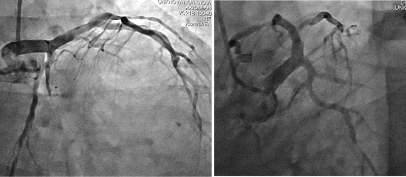 Coronary angiography showing significant disease of left circumflex and obtuse marginal artery.