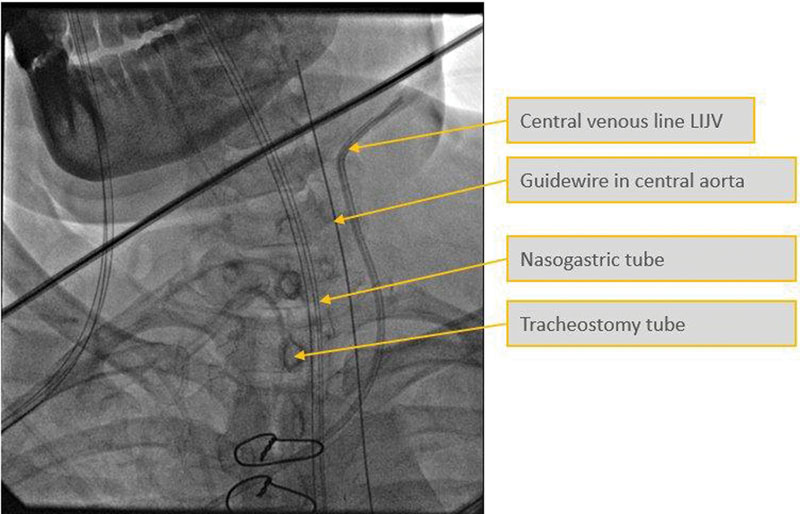 Snapshot of fluoroscopy picture showing the guidewire in the carotid artery. LIJV, left internal jugular vein.