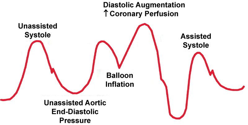 Intra-arterial balloon pump waveform.