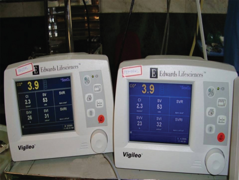 Simultaneous monitoring of cardiac output/cardiac index, SVV, and SV for radial and femoral arteries using FloTrac/Vigileo.