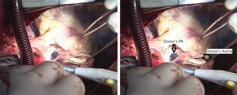 Transected aorta. Donor’s pulmonary artery (PA) is being transected.