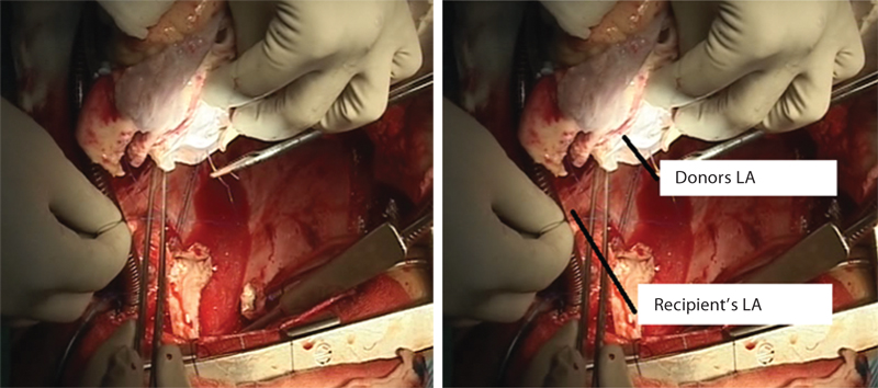 Donor’s left atrium (LA) is being sewn into the recipient’s LA.