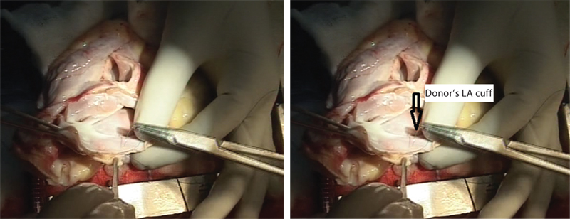 Sutures are being taken on donor’s left atrial cuff for anatomosis into recipient’s left atrium (LA).