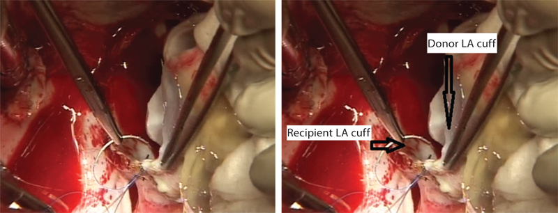 Donor’s left atrium (LA) is being sewn into the recipient’s LA.