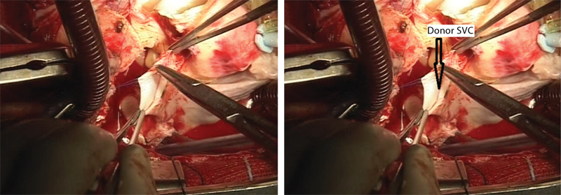 Donor’s superior vena cava (SVC) is being sewn into the recipient’s SVC.