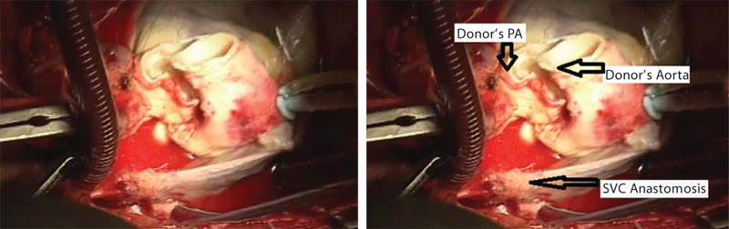 Final anastomosis of superior vena cava (SVC). PA, pulmonary artery.