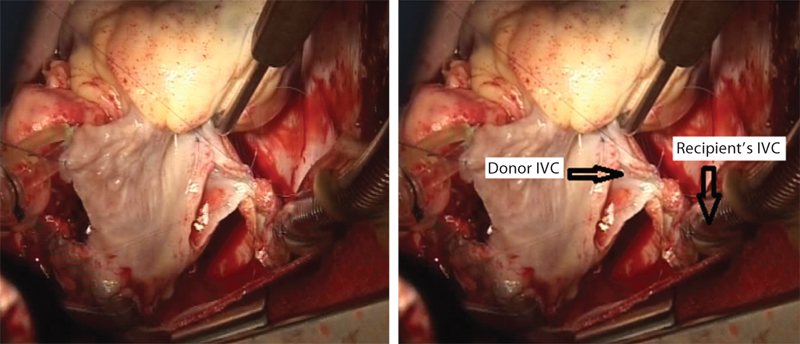 Donor’s inferior vena cava (IVC) is being sewn into the recipient’s IVC.