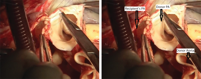 Donor’s pulmonary artery (PA) is being sewn into the recipient’s PA.