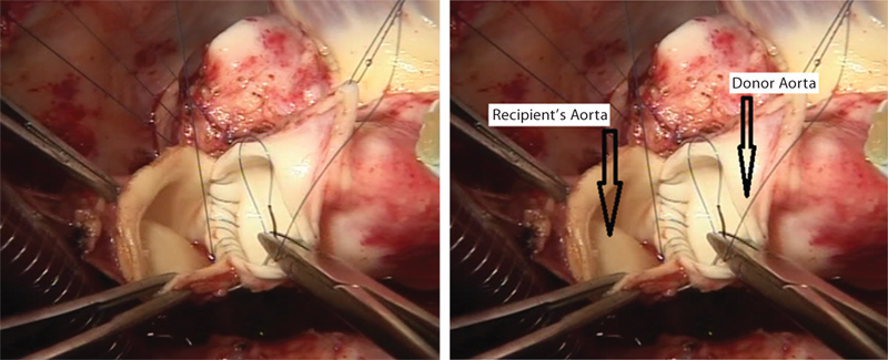Donor’s aorta is being sewn into the recipient’s aorta.
