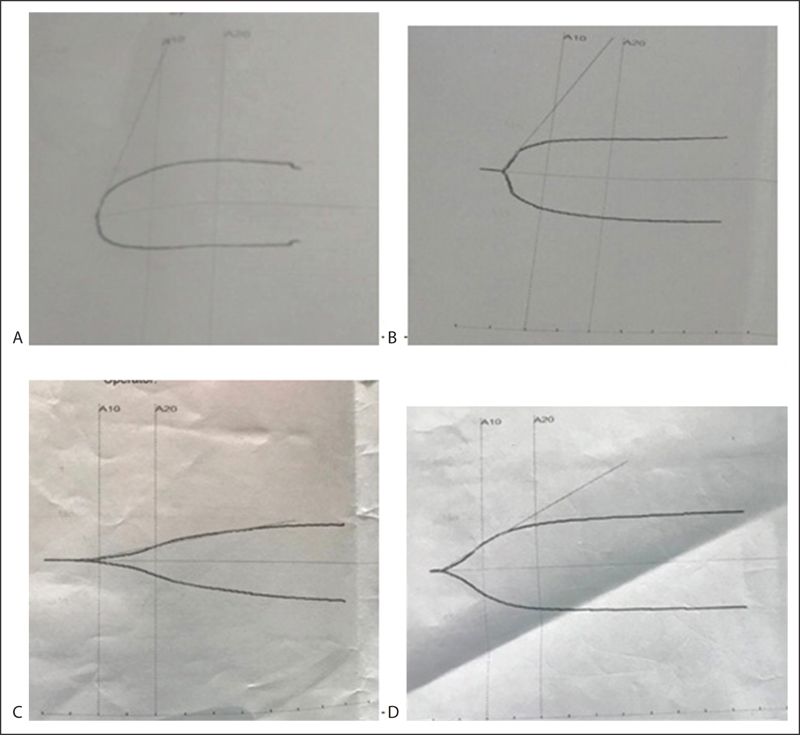 Thromboelastography tracings. (A) Hypercoagulable state, (B) normalization of trace, (C) hypocoagulable state, (D) normal trace after reversal with protamine post decannulation of ECMO.