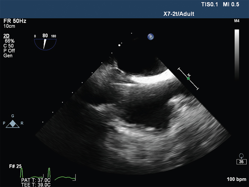 Mid oesophageal bicaval view showing guide wire in right atrium.