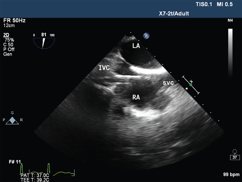 Mid oesophageal Bicaval view showing venous cannula in right atrium. IVC , inferior vena cava; LA, left atrium; RA, right atrium; SVC, superior vena cava.