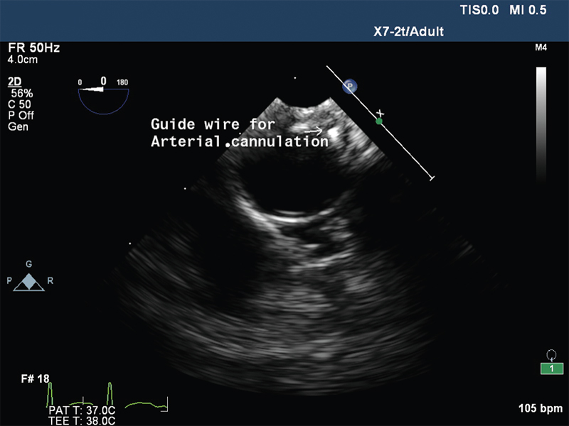 Descending thoracic aorta short axis view showing guide wire.