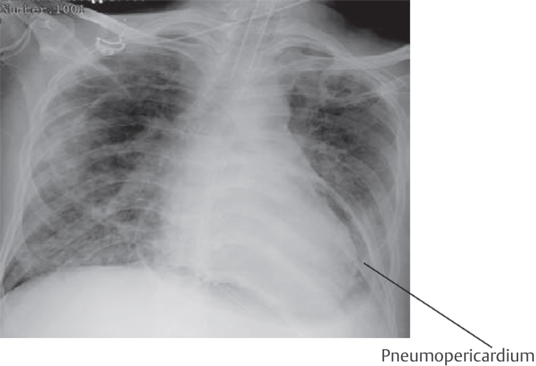 Pneumopericardium on chest X-ray.