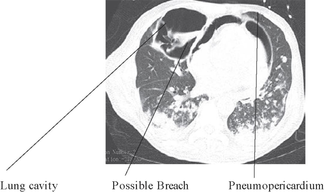 CT of the chest showing lung cavity and pneumopericardium.