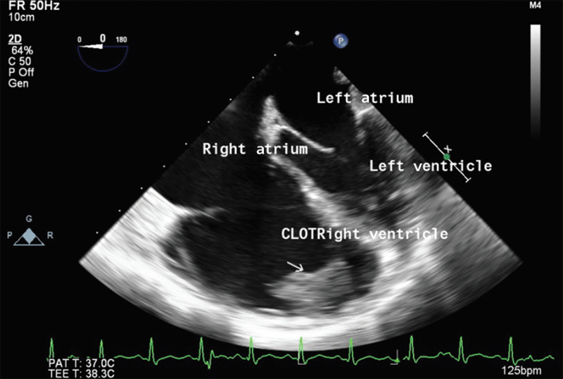 Mid-esophageal four-chamber view showing thrombus in right ventricle.