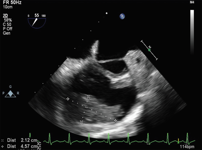 Mid-esophageal aortic valve short-axis view.