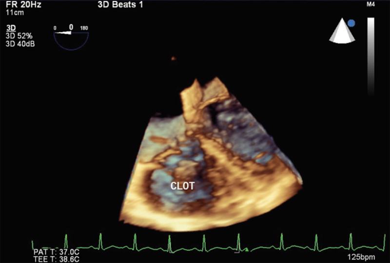 Three-dimensional reconstruction showing tricuspid valve attachment (anterior leaflet of tricuspid valve).