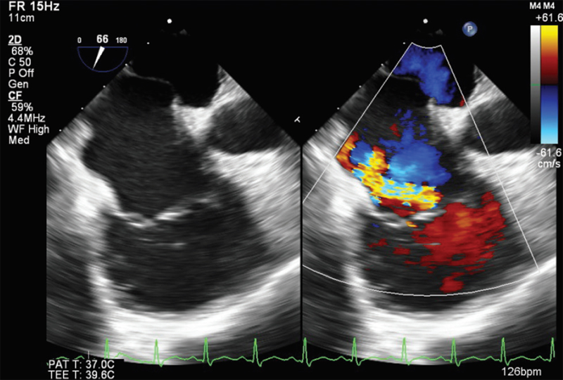 Mid-esophageal right ventricular inflow–outflow view showing eccentric jet across tricuspid valve.