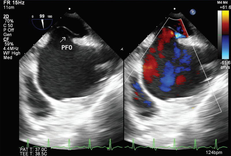 Modified bicaval view showing patent foramen ovale (PFO).