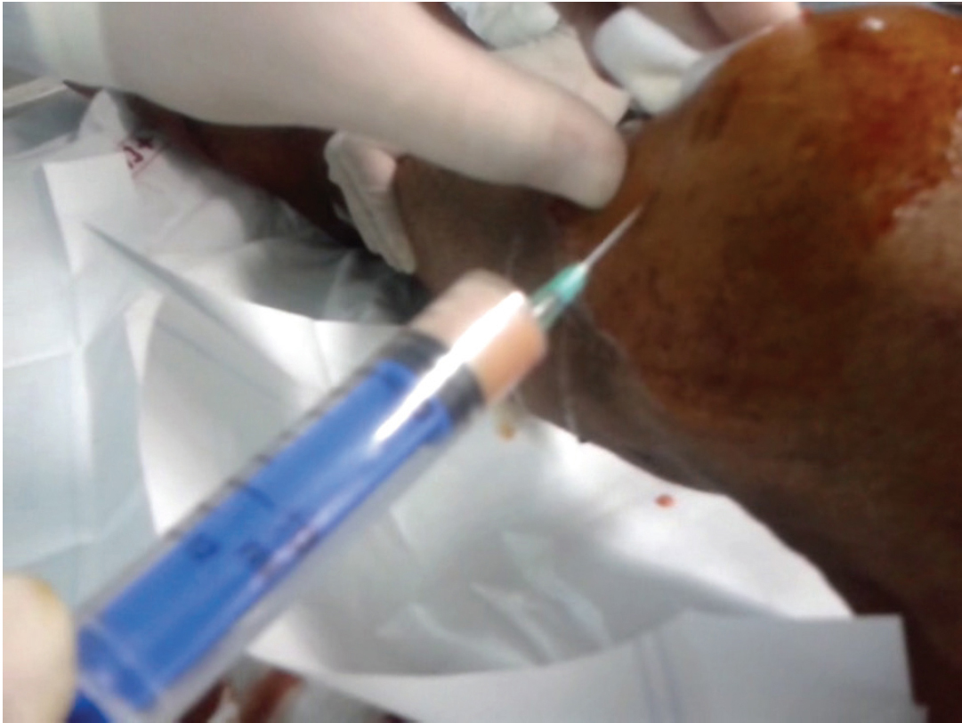 Pus being aspirated from the knee joint