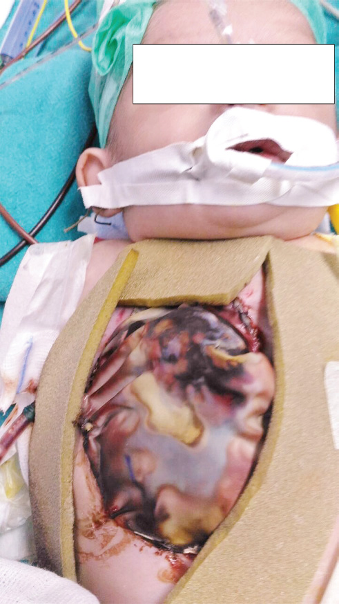 Pentalogy of Contrell: Primary coverings using PTFE (polytetrafluoroethylene) graft and bovine pericardium for chest and abdominal defects respectively. Both the primary covers are again covered by sterile blood bag.