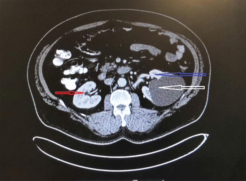 Computed tomography scan of abdomen showing right kidney (red arrow), left kidney (blue arrow), and left renal mass (white arrow).