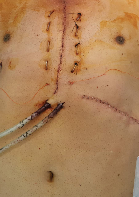 Skin incisions of chest and abdomen.