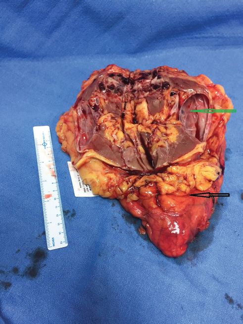 Surgical specimen showing cystic left renal mass (green arrow) and left kidney (black arrow).