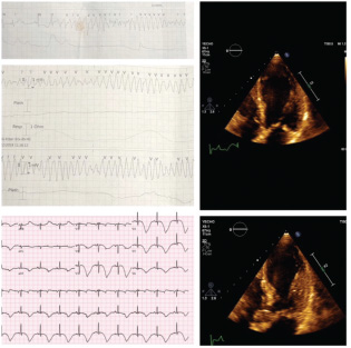 Electrocardiogram showing run of polymorphic ventricular tachycardia and diffuse T-wave inversions, echocardiogram showing akinesia of apical segments.