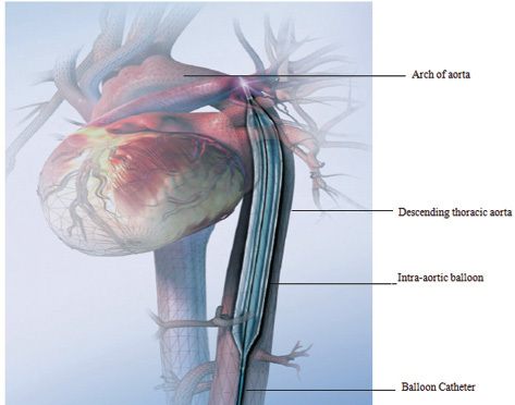 Intra-aortic balloon in position. (Courtesy Getinge.)