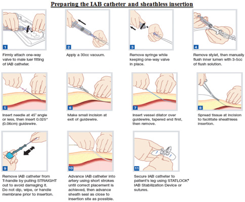 Intra-aortic Balloon Pump—Current Status - Journal of Cardiac Critical ...