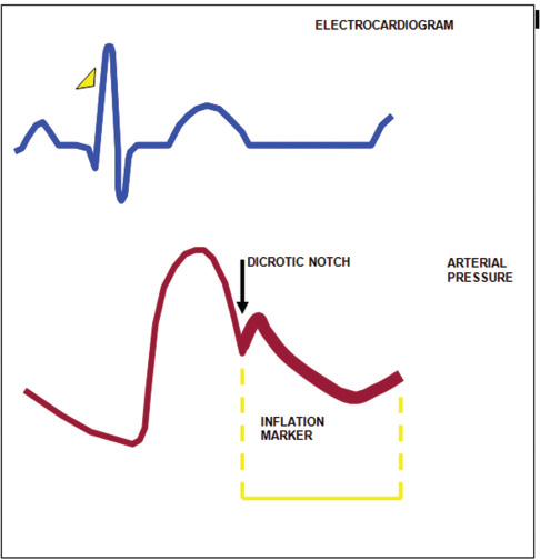 The balloon is inflated during diastole, and inflation is timed to coincide with dicrotic notch of arterial waveform.