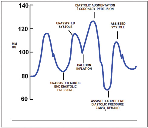 Arterial waveform variations during IABP therapy. Arterial pressure is shown on the vertical axis.