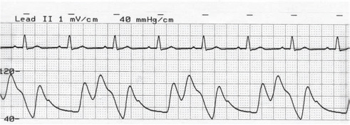 Optimal timing of inflation of IABP balloon. The arterial pressure tracing and corresponding ECG is shown. Note inflation during diastole at the rate of 1:2.