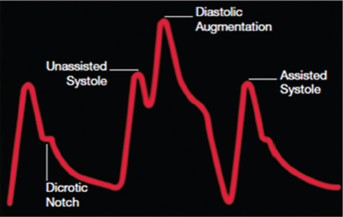 Arterial tracing with early inflation. Early inflation occurs when the balloon inflates prior to aortic valve closure; then there will be insufficient blood in the aorta, resulting in a decrease coronary blood flow, premature closure of aortic valve, and increased afterload.