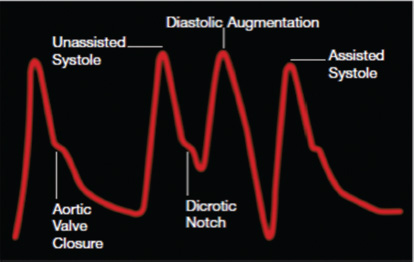 Arterial tracing with late inflation. Late inflation occurs when the balloon inflates too late after the closure of the aortic valve and blood escapes down the aorta to the rest of the body, instead of being directed to the coronary arteries.