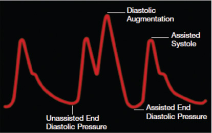 Arterial tracing with early deflation. Early deflation causes retrograde blood flow to the coronary arteries and affecting forward blood flow to other vessels and increase in afterload.