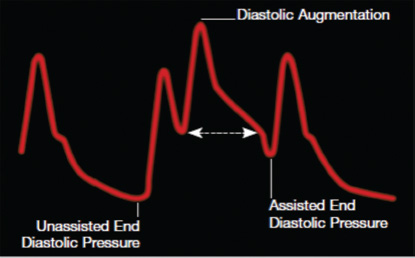 Arterial tracing with late deflation. Late deflation has the effect of impeding left ventricular ejection, causes ventricular wall stress, and impedes afterload reduction.