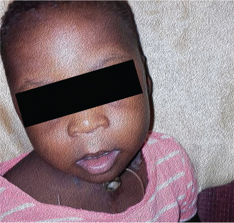 The child with tracheostomy tube without oxygen at home at 8 months after surgery in Nigeria.