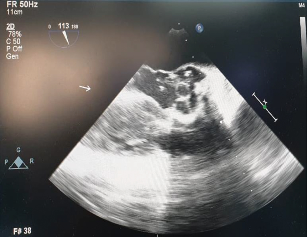 Midesophageal aortic valve long axis view demonstrating multiple thrombi in the prosthetic aortic valve.