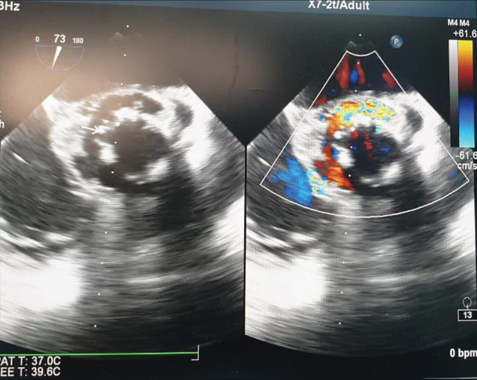 Midesophageal aortic valve long axis view measuring the aortic annulus and proximal ascending aorta.