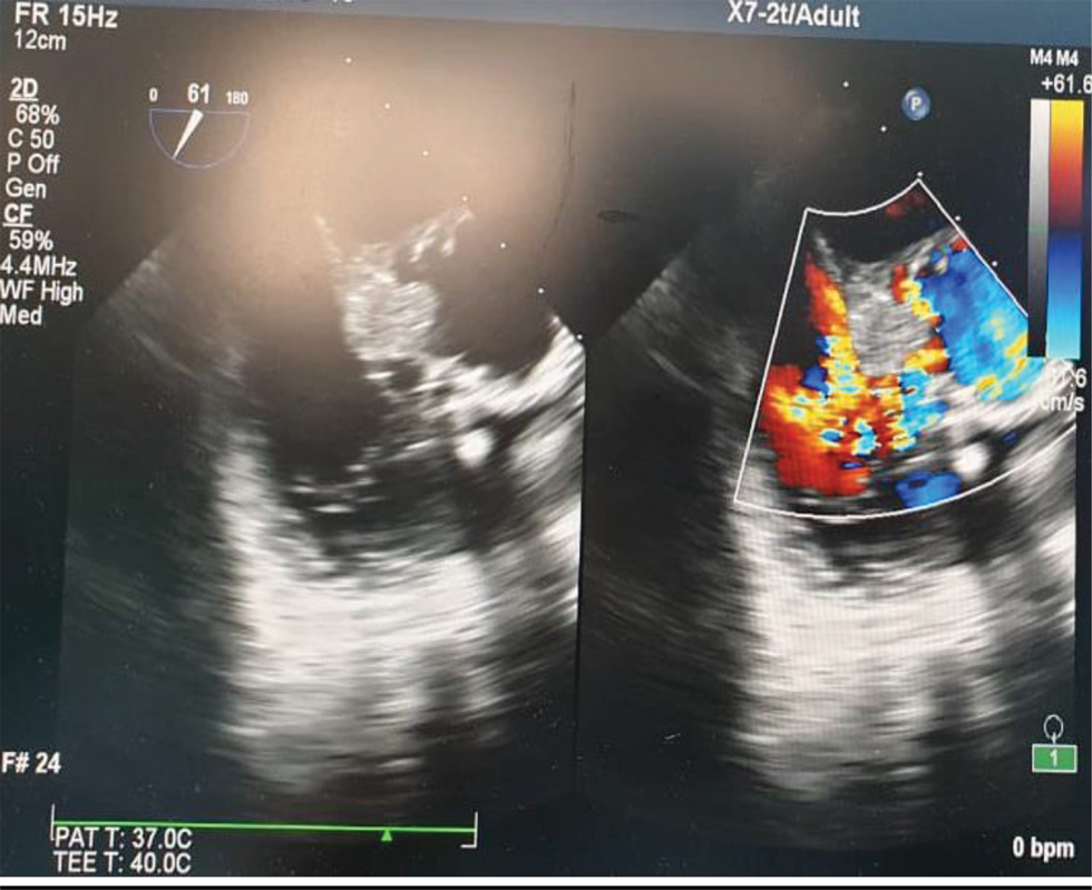 Color M mode assessment of aortic regurgitation.