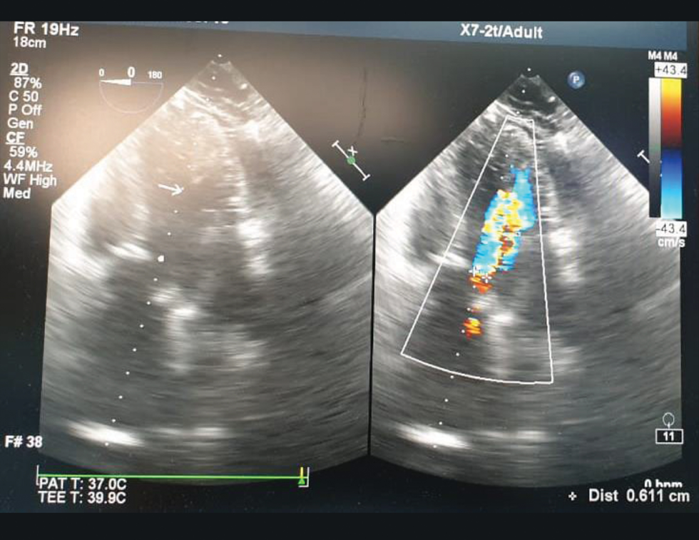 Pressure half time for assessment of regurgitant severity.