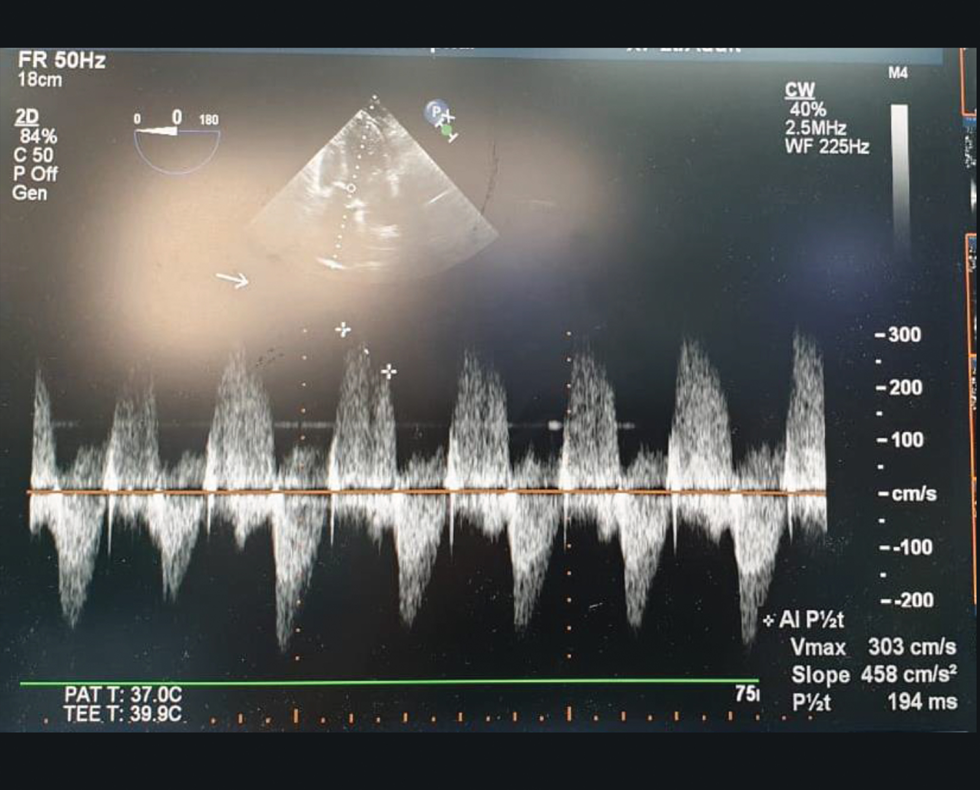 Pericardial effusion around LV posterior wall.